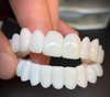 DentAlign tandfasader – Naturlig passform och komfort
