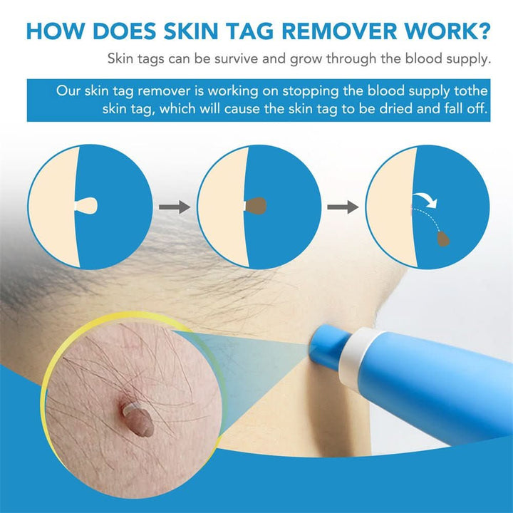 Dermaswift – Ta bort hudfläckar mot vårtor och hudutväxter