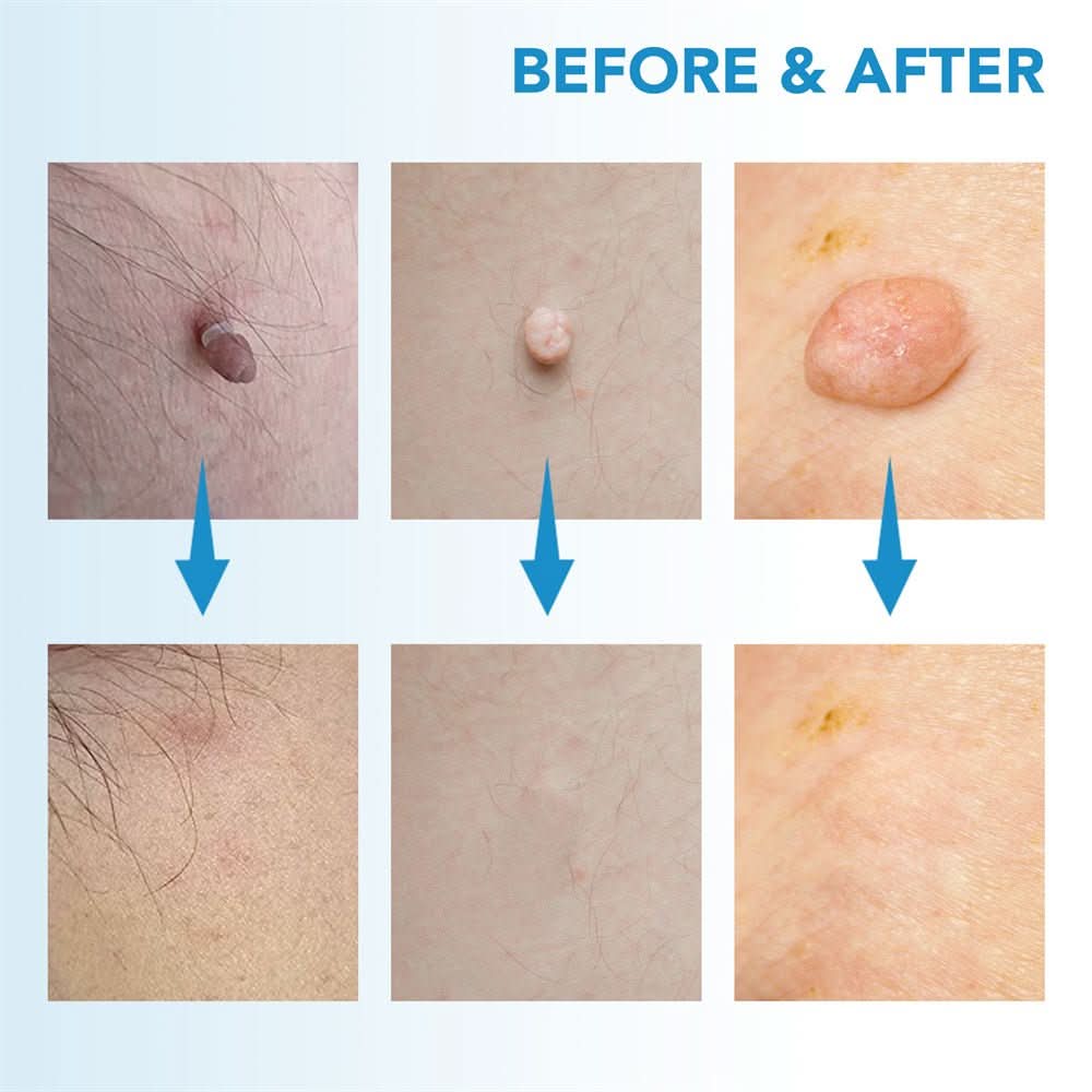 Dermaswift – Ta bort hudfläckar mot vårtor och hudutväxter