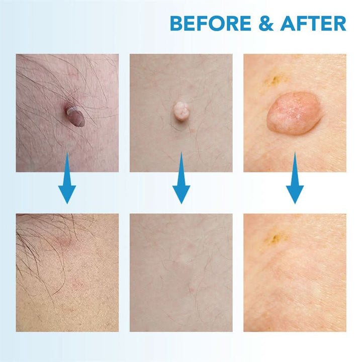 Dermaswift – Ta bort hudfläckar mot vårtor och hudutväxter
